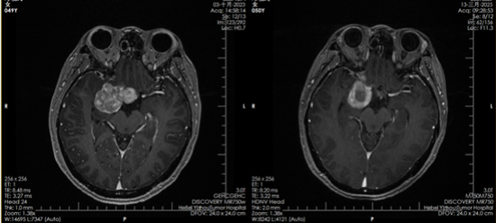 河北一洲肿瘤医院质子中心：为复发垂体瘤患者点亮希望