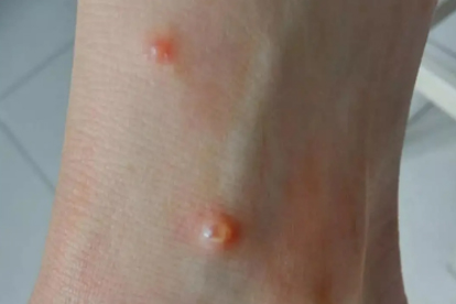 生殖疱疹1型是不是性疾病