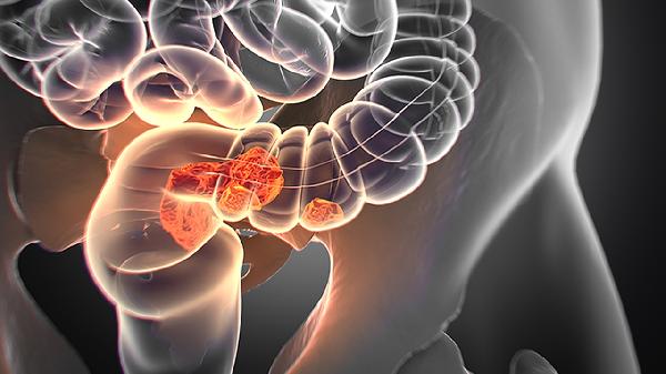 结直肠癌易错失良机？这些检查真能轻易省略吗？一文讲清楚