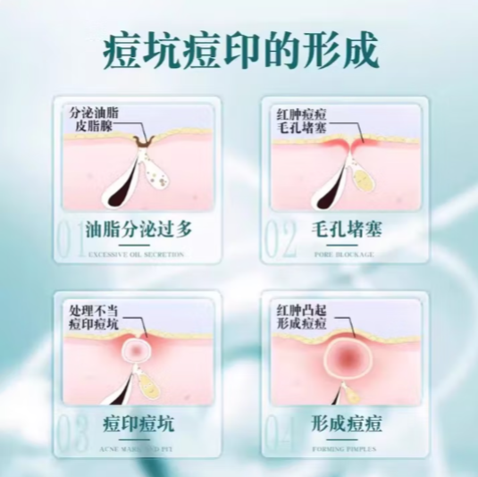 痘痘肌去痘印用什么好？2025评价好用去痘去痘印5大品牌推荐