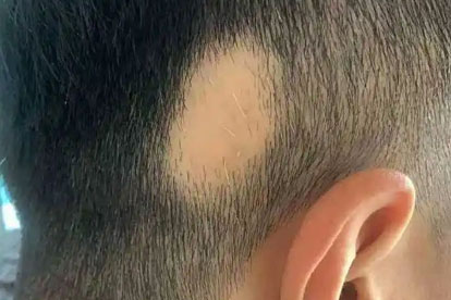 提醒：白头发多了不一定是变老了，可能缺乏这几种营养素