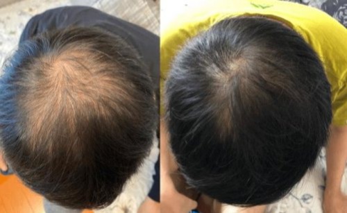 毛囊萎缩终极解决方案有了！2025毛囊焕活十大品牌测评，榜首优势明显！