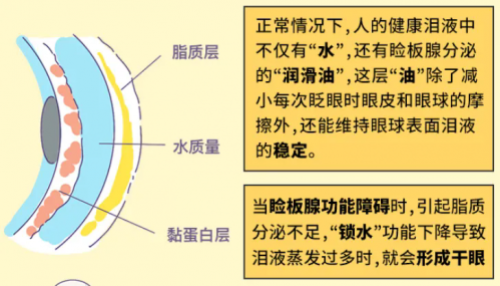 宁夏爱尔眼科医院分享：别硬扛了!打败磨人的“干眼症”？你需要这份科学通关攻略