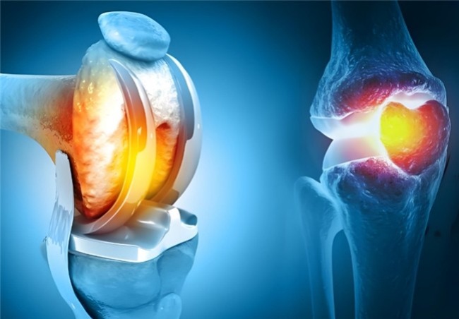 直击根源护软骨,应对骨关节炎选硫酸还是盐酸氨基葡萄糖胶囊?