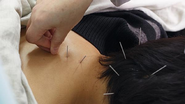 针灸去皱纹做多久见效