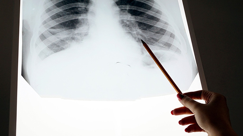 医生提醒:一旦被查出肺癌,5件事不能再做了,小心病症迅猛恶化