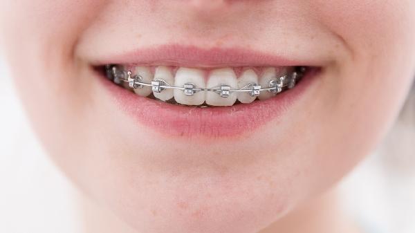 金属牙套价格一般是多少钱一个