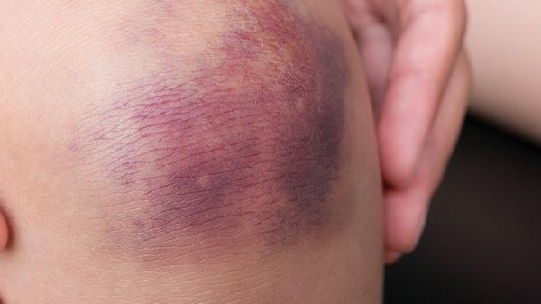 脸部被打淤青怎么消除