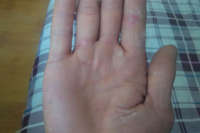 手掌真菌感染用艾灸