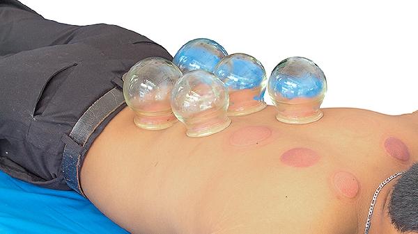 拔罐后有哪些注意事项