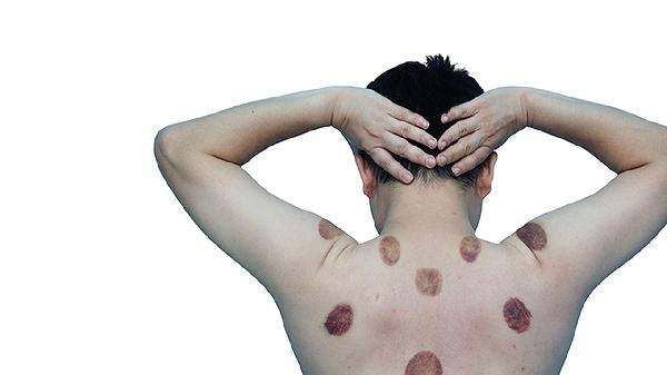 腰间盘突出拔罐的好处