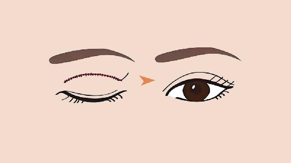 埋线双眼皮先开眼角还是先埋线