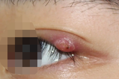 麦粒肿开刀会有疤痕吗