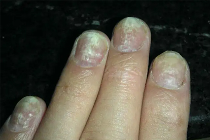 指甲形状难看怎么矫正