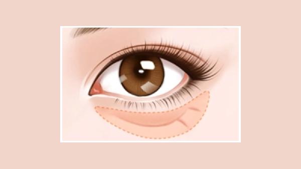 眼袋没有办法消除吗