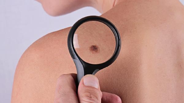 有什么办法可以淡化红胎记呢