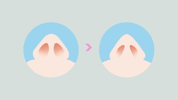 做鼻孔整形能永久吗