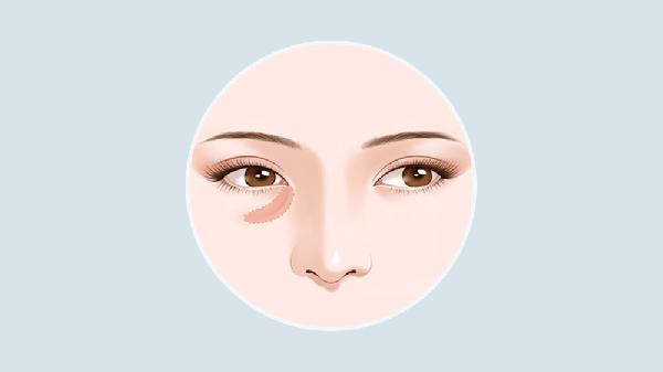 怎样可以有效的消除泪沟