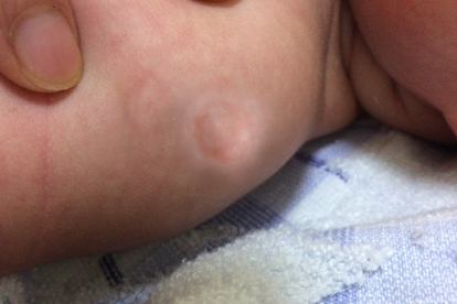 中医能消除脂肪瘤吗