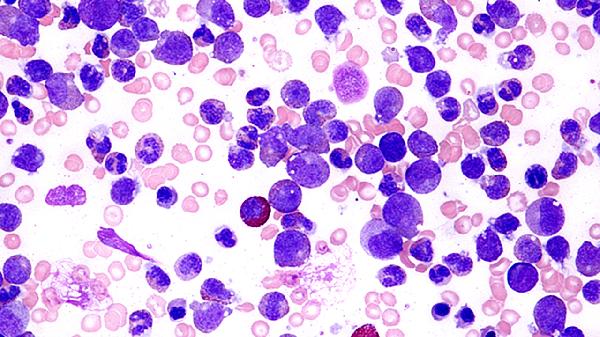 血常规单核细胞偏高原因