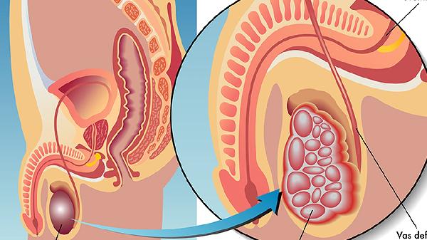 怎样预防睾丸扭转