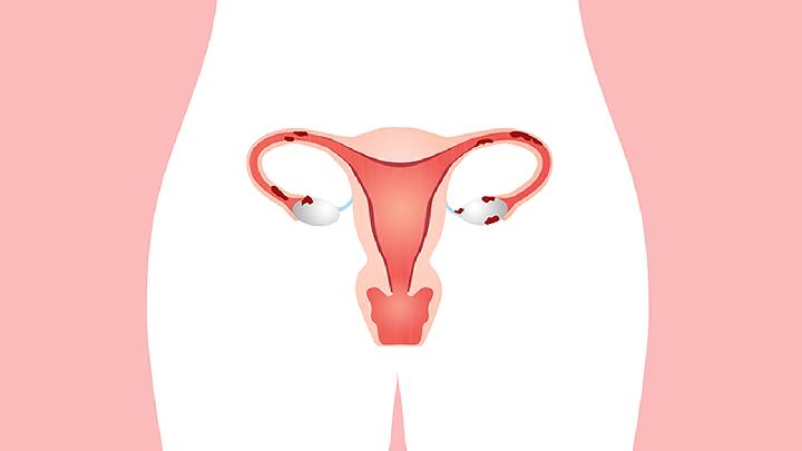 宫颈息肉摘除后还会复发吗