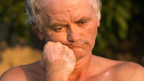 阿昔洛韦片老人能多吃吗