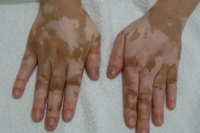 治白癜风的驱白巴布期片有激素吗