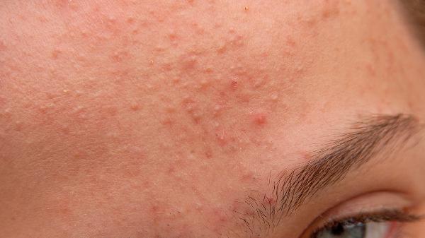 有痤疮吃复方木尼孜其颗粒效果怎么样