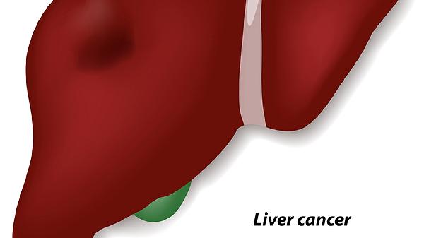 养正消积胶囊对肝癌是否有抑制作用