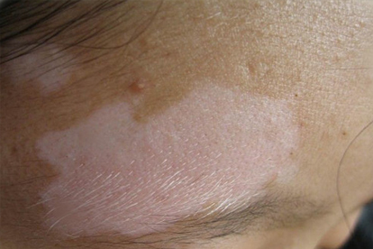 驱白巴布期片治疗白癜风有用吗