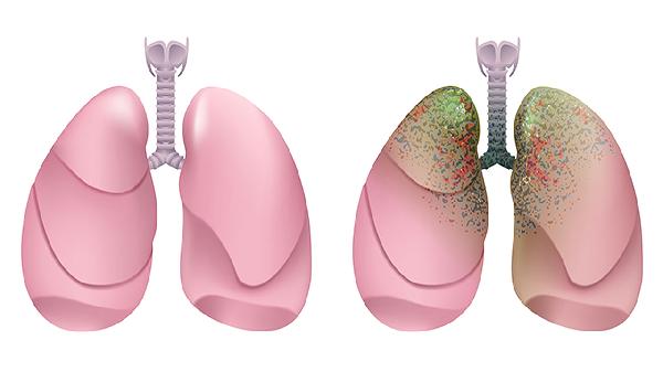 通宣理肺丸主要治什么病