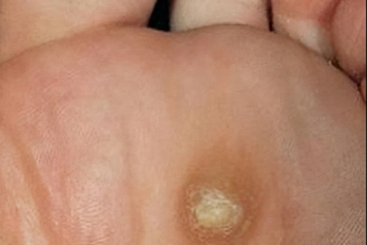 鸡眼草主要适用于什么病