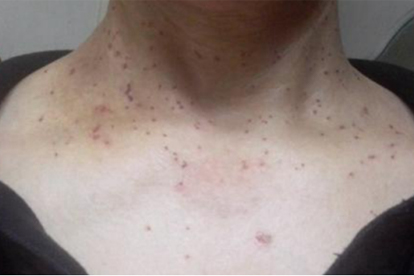 眼角长扁平疣怎么去除