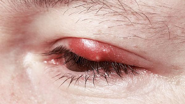 眼皮突然肿了怎么回事