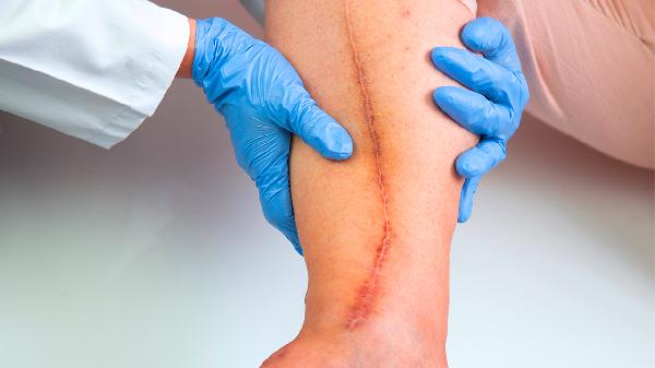 抓伤的疤痕如何淡化