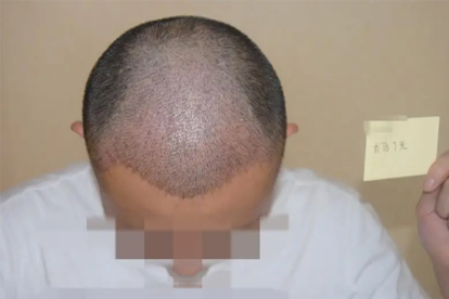 植发后痛得让人受不了怎么办