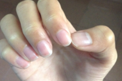 指甲矫正器有效果吗