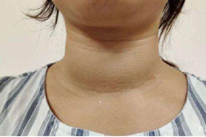 甲状腺结节能消失吗