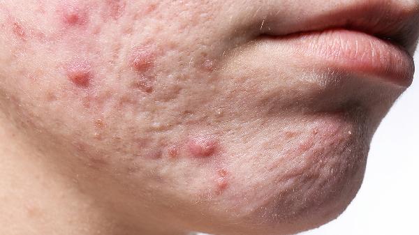 下巴长痤疮用什么药膏