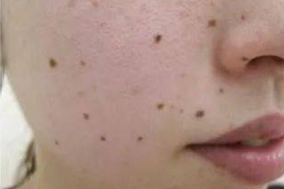 药水点痣好还是激光点痣好