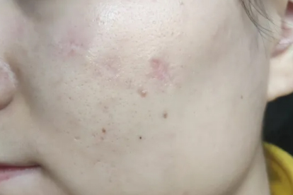 去痘印最有效的药膏