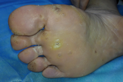 跖疣抹药变成小水泡