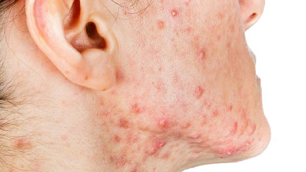 痤疮用什么消炎药