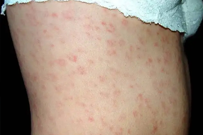 梅毒不吃药可自愈吗