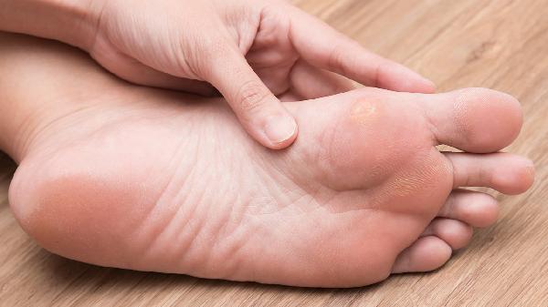 跖疣上药后起血泡