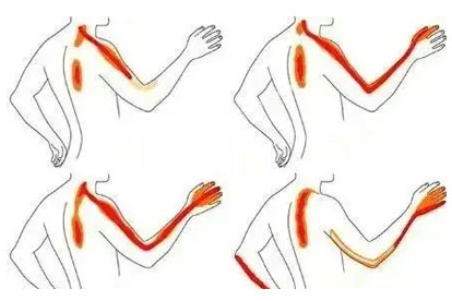 肩周炎疼痛吃什么药