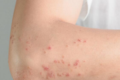 湿疹可以吃氯雷他定片吗