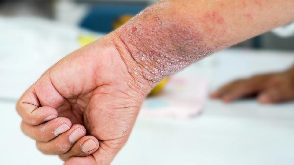 这类病不疼不痒，却能一步步榨干你的肾！出现这些征兆一定要重视