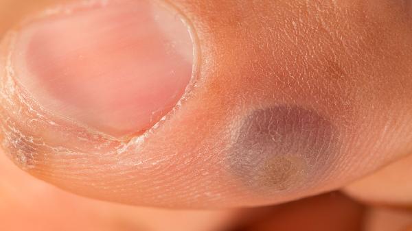 治疗尖锐湿疣的中成药